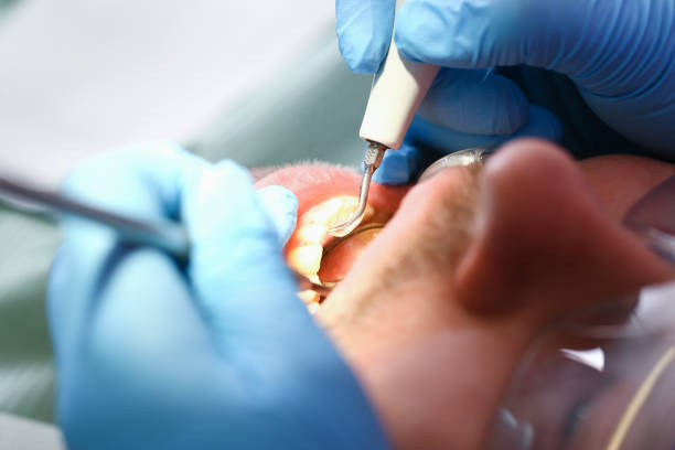 Best Emergency Wisdom Tooth Extraction in Mercedes, TX